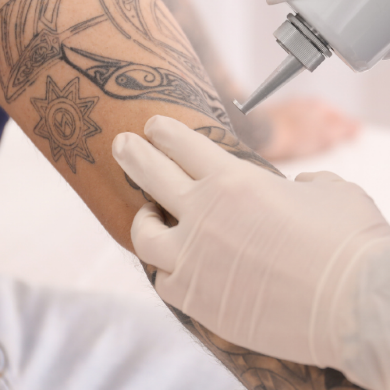 Aluguel de Equipamentos Laser de Tirar Tatuagem Valores Novo Eldorado - Locação de Laser para Remoção de Tatuagem Belo Horizonte
