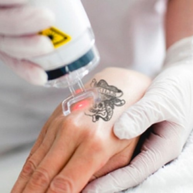 Aluguel de Laser para Despigmentação com Registro Anvisa Patrocínio - Locação de Laser para Remoção de Tatuagem