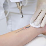 aluguel de laser para remoção de tatuagem valores Brumadinho