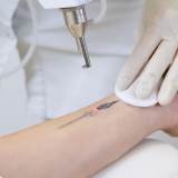 curso de remoção de tatuagem colorida a laser preço Rio Acima